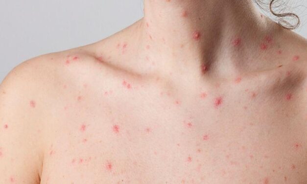 Autoridades confirman tres casos de viruela del mono en Colombia